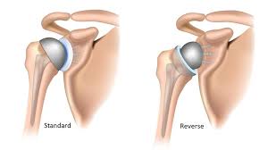 Shoulder Replacement Surgery in Pune